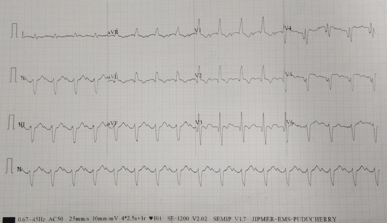 Cardiology window Trifascicular block