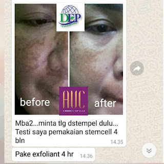 Testimoni Sabun Amoorea 4 hilangkan flek hitam di wajah parah dengan amoorea