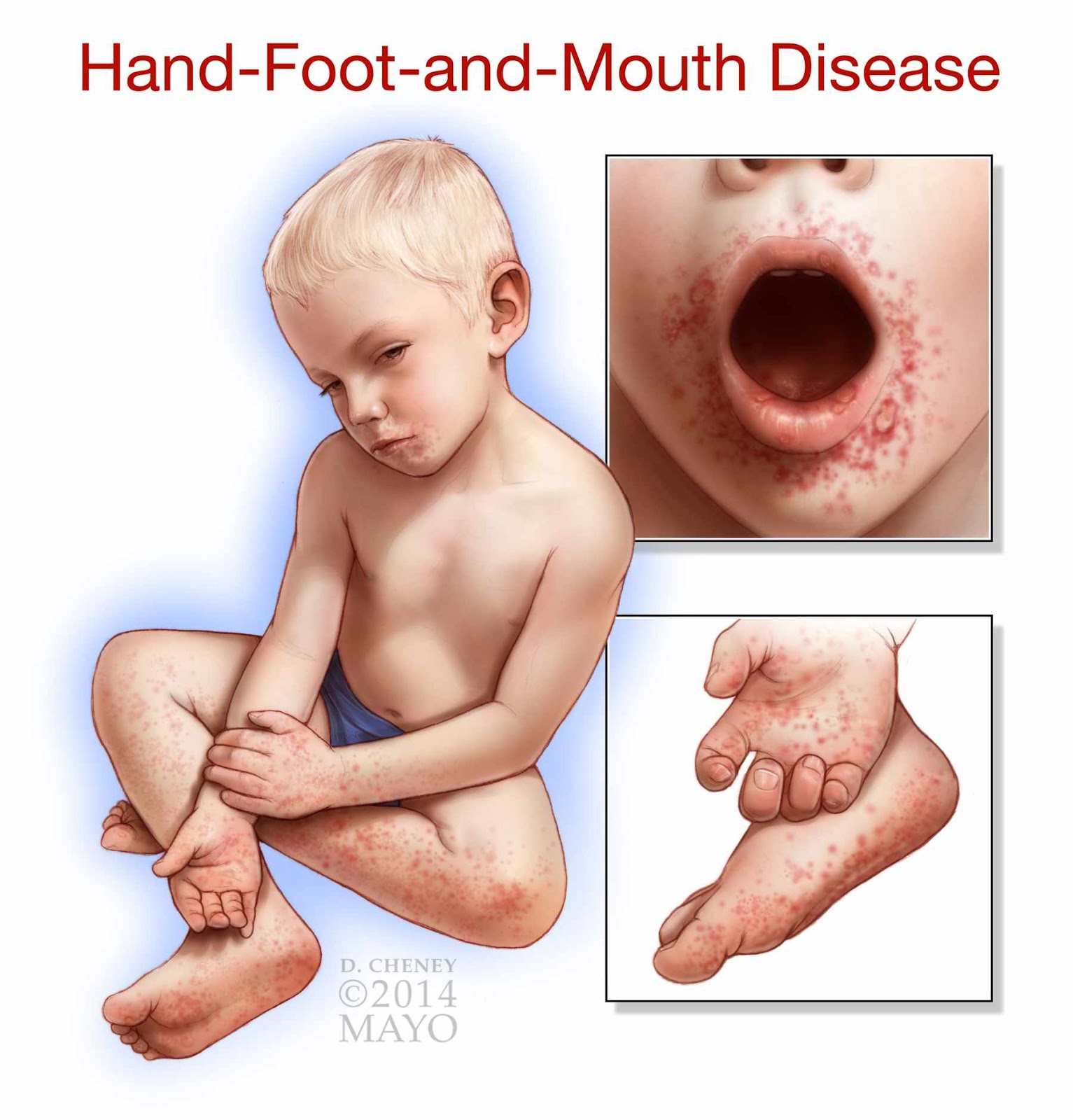 Hand Foot Mouth Disease hand-foot-mouth-disease