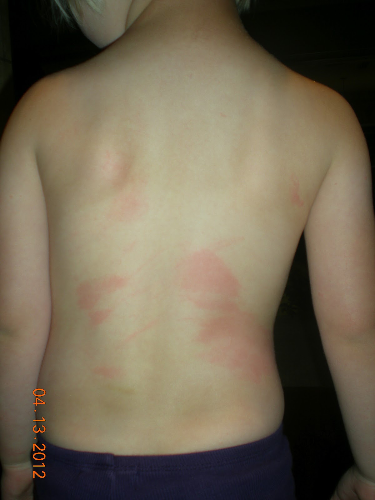 Party of Six Riley and The Rash