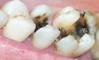 Tooth Decay Treatment Tips