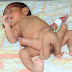 Bayi Berkaki 6 Lahir di Pakistan