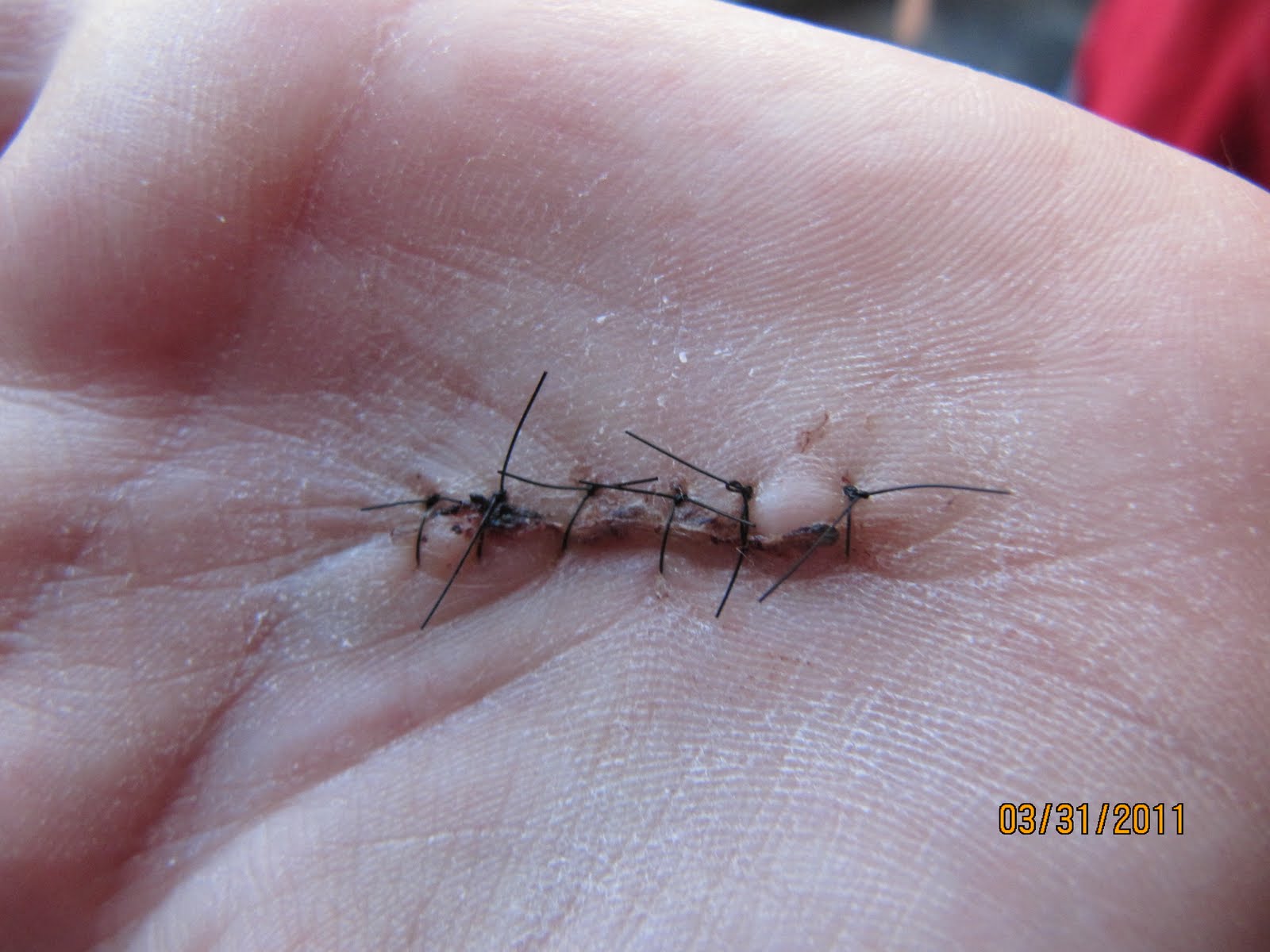 How To Care For Stitches On Palm Of Hand After this, you can shower