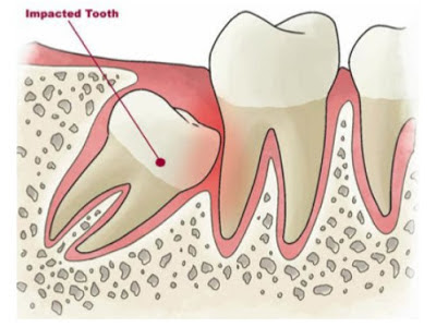 Mọc răng khôn có ảnh hưởng gì không?