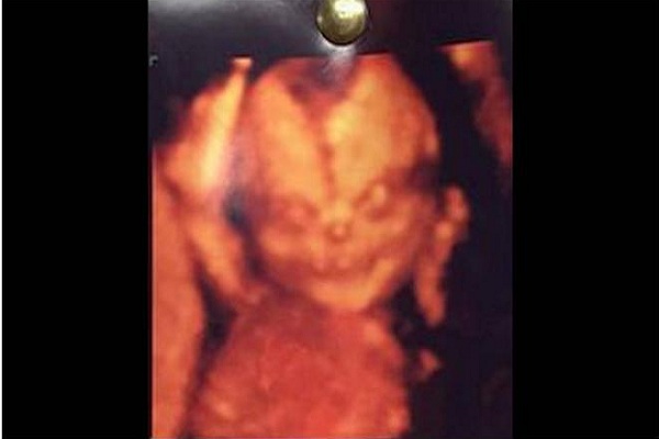 foto usg bayi paling mengerikan dan juga menyeramkan yang membuat bulu kuduk berdiri-11