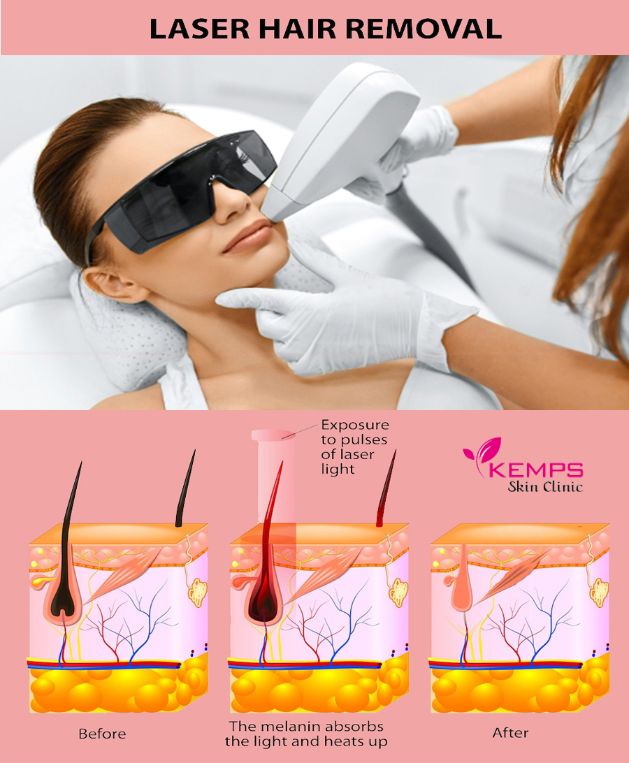 How does laser hair removal treatment work? 