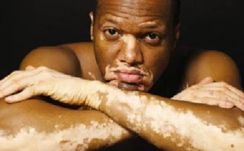Vitiligo disease