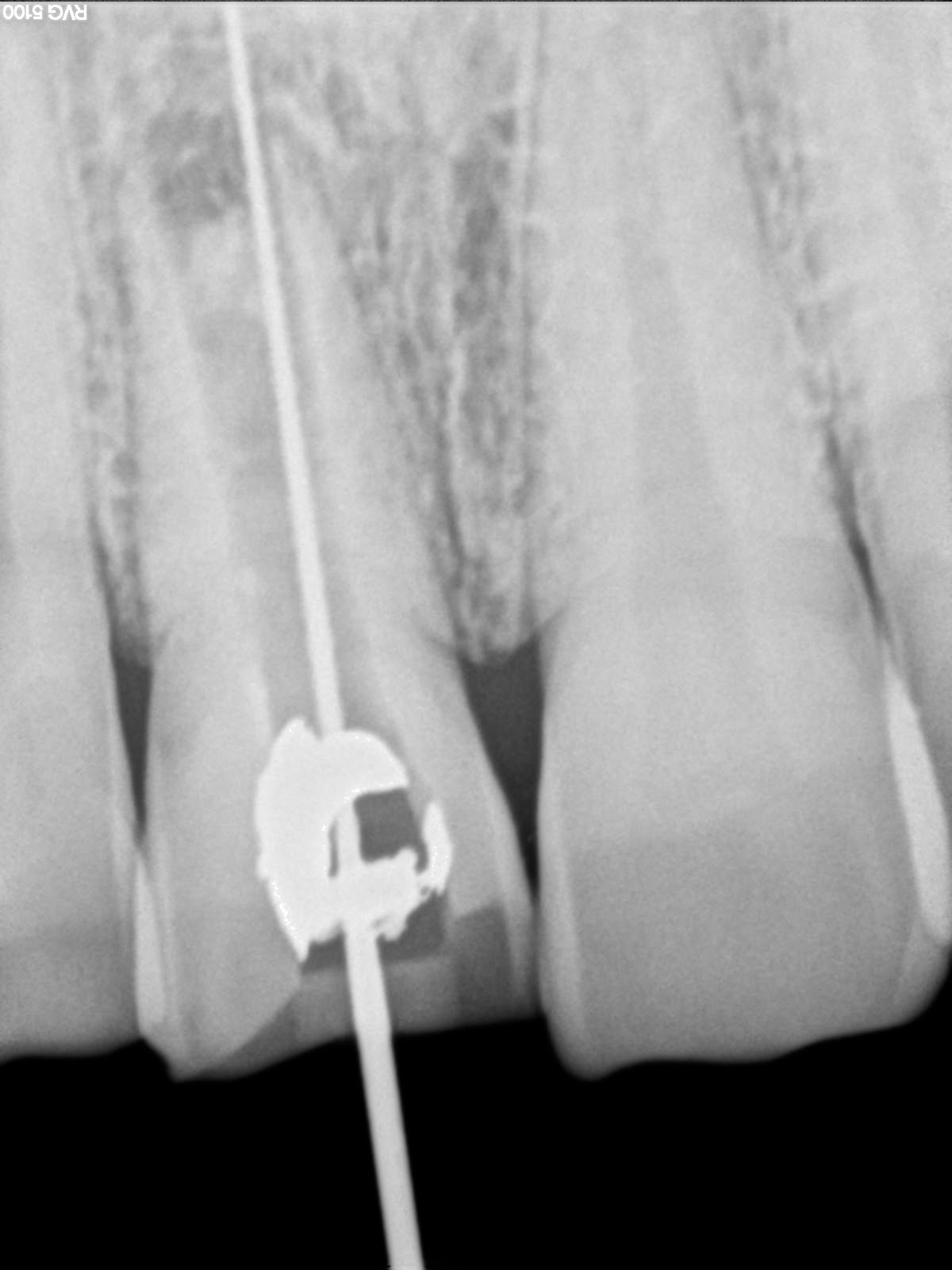 Endodontics Re rootcanal treatment with open apex central incisor