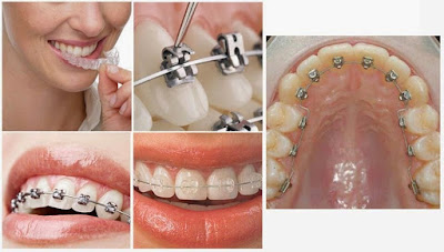 Ưu điểm của niềng răng và bọc răng sứ