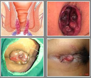 cara mengobati ambeien yang muncul usus dari anus