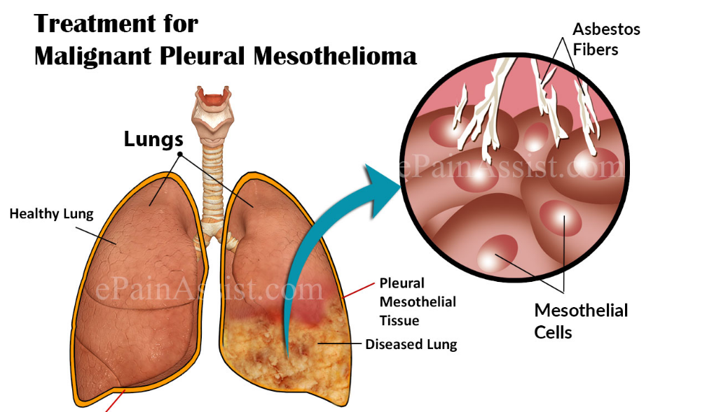 Elective, Natural and Complementary Mesothelioma Treatments