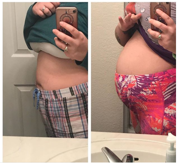 Endometriosis Awareness Endo Belly