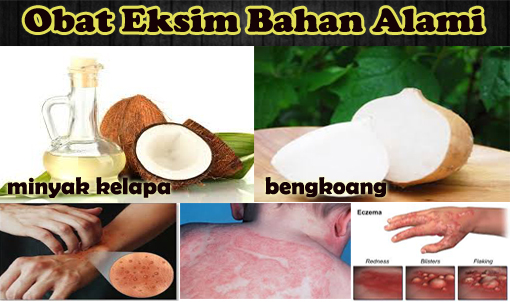 Foto Obat Kulit Gatal dan Alergi Salep Exclear dan Bersih Darah