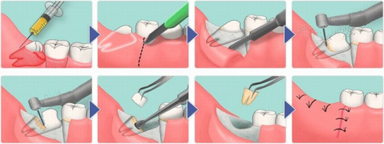 PROCEDURA DI ESTRAZIONE - VARI STEP.