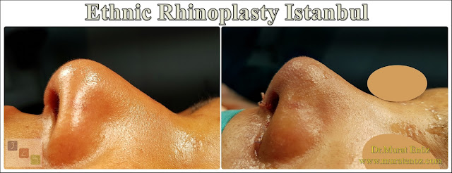 Ethnic Rhinoplasty Istanbul – Dr.Murat Enoz – Nose job in Istanbul – Nose surgery in Istanbul – Nose job in Turkey - Ethnic rhinoplasty Turkey - Ethnic rhinoplasty in Turkey - African American rhinoplasty - Ethnic expert nose job surgeon - Rhinoplasty surgeon in Istanbul - Black nose job - Rhinoplasty for ethnic nose - Rhinoplasty for African people - African American nose surgery – Rhinoplasty for African American Nose - Thick skin rhinoplasty - Rhinoplasty in istanbul Ethnic Rhinoplasty Istanbul – Dr.Murat Enoz – Nose job in Istanbul – Nose surgery in Istanbul – Nose job in Turkey - Ethnic rhinoplasty Turkey - Ethnic rhinoplasty in Turkey - African American rhinoplasty - Ethnic expert nose job surgeon - Rhinoplasty surgeon in Istanbul - Black nose job - Rhinoplasty for ethnic nose - Rhinoplasty for African people - African American nose surgery – Rhinoplasty for African American Nose - Thick skin rhinoplasty - Rhinoplasty in istanbul