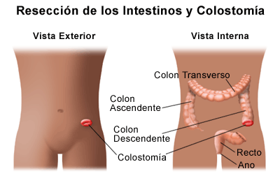 ostomía enfermedad inflamatoria intestinal