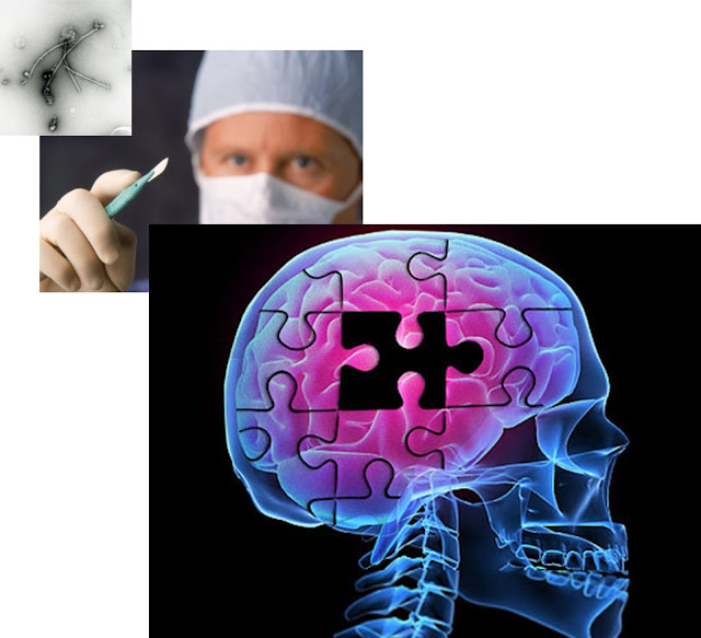 https://www.newscientist.com/article/mg23731661-900-surgical-instruments-may-spread-alzheimers-proteins/