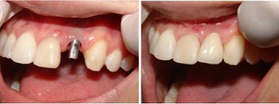có nên cắm ghép răng implant không -3 có nên cắm ghép răng implant không -3