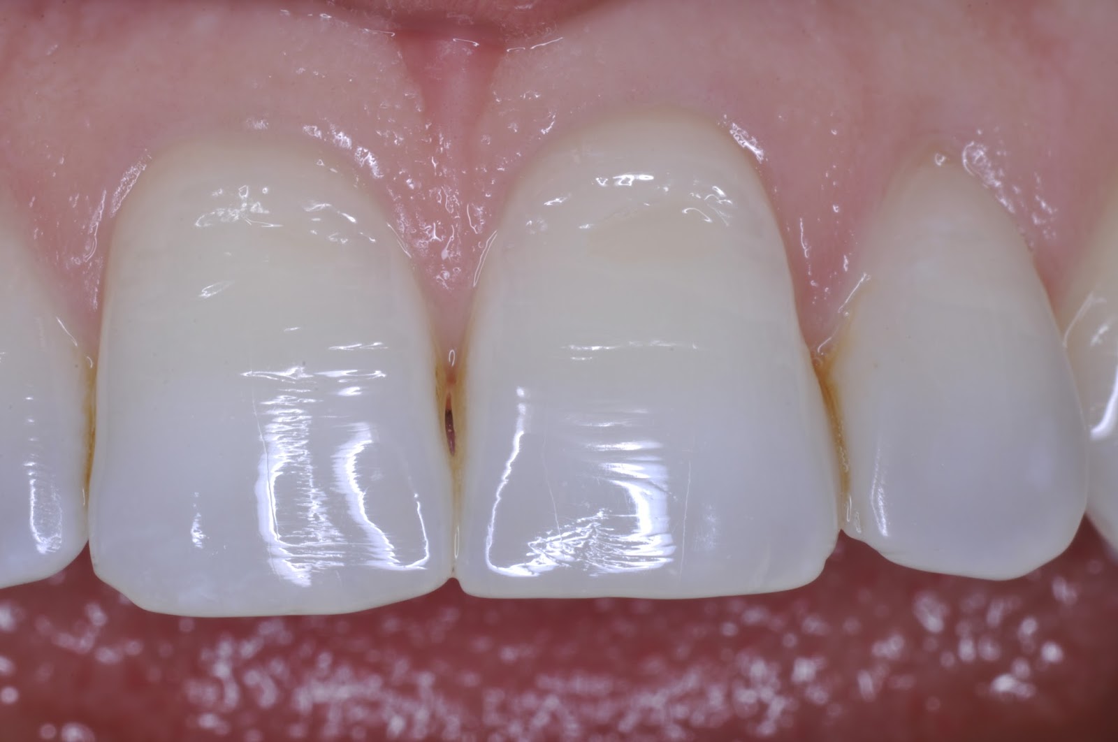 How To Fix Hole In Tooth Those cavities can be treated with fillings
