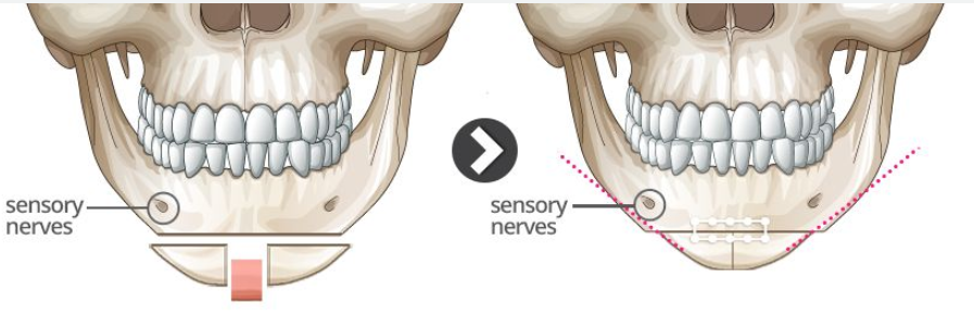 Ментальное отверстие нижней челюсти. Угол молодости. Скошенный подбородок ментопластика. Без подбородочного выступа. Остеотомия нижней челюсти.