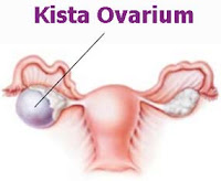 Penyebab, Gejala serta Pengobatan Kista Ovarium Penyebab, Gejala serta Pengobatan Kista Ovarium