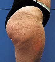 Was ist Cellulite und wie entsteht es