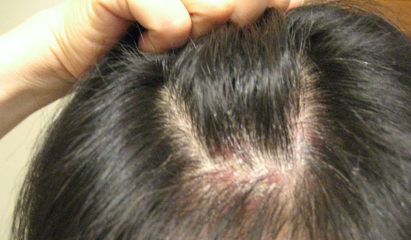 All About Girls How To Treat Head Pimples In Correct Way