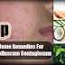 Top 8 Home Remedies Ultimate Molluscum Contagiosum