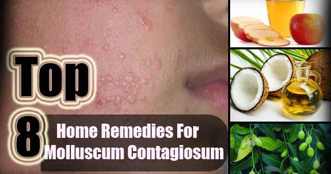 Top 8 Home Remedies Ultimate Molluscum Contagiosum Natural Remedies