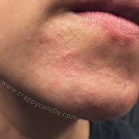 Hydrocortisone Triggered Chin Perioral Dermatitis :: CrappyCandle.com