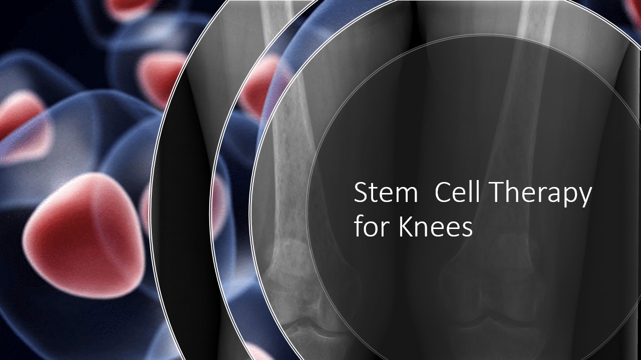 Stem Cell Therapy for Knees Reviews, Evidence, Effectiveness and Cost