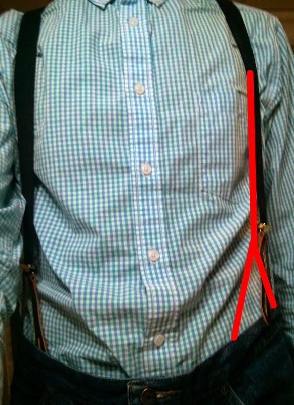 the invisible braces Ramblings of a BraceWearer A Popped Button