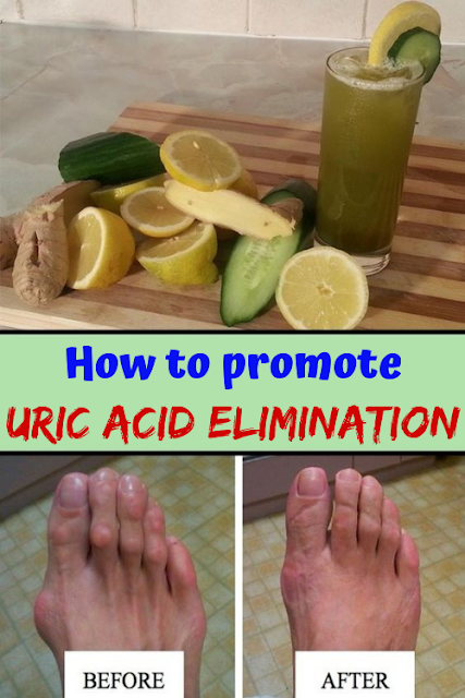 How To Promote URIC ACID Elimination Naturalcreambeauty how-to-promote-uric-acid-elimination-naturalcreambeauty