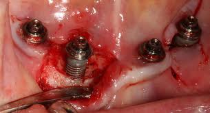 cirugia para limpiar implante con infeccion