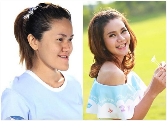 17 Foto Menakjubkan Wanita Thai Sebelum Dan Selepas Pembedahan Plastik 17 Foto Menakjubkan Wanita Thai Sebelum Dan Selepas Pembedahan Plastik