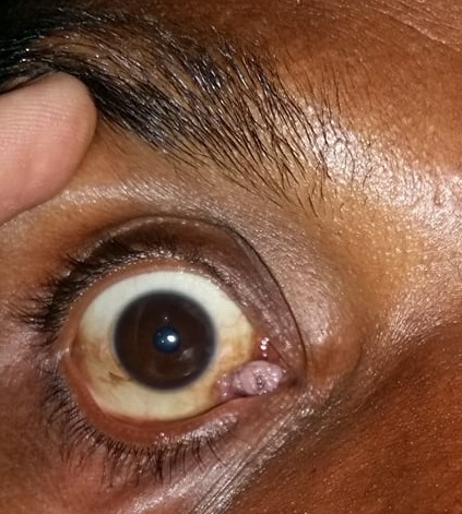 Caruncle Cyst on eye