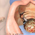13 signes que le cancer de l’ovaire se développe dans votre corps