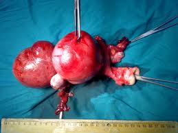 fibroid & kesuburan Set Fibroid Shaklee