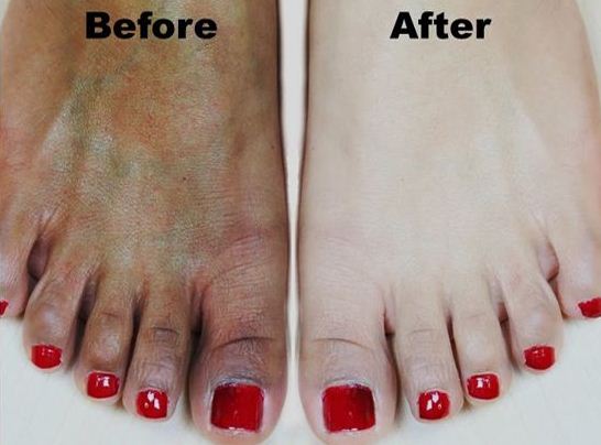 How to Lighten Skin Naturally and Permanently?