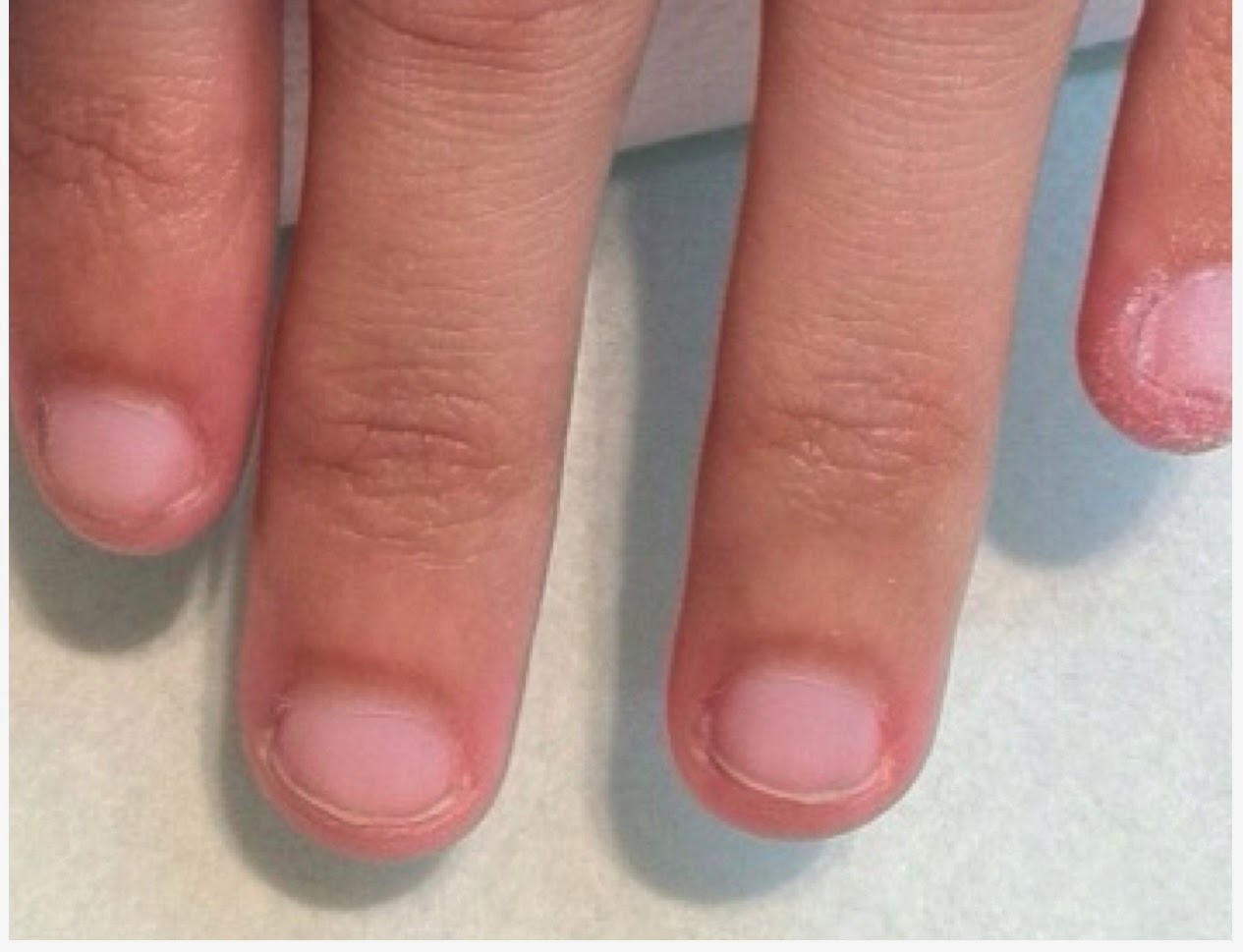 Uñas Mordidas Crecen Hacia Arriba