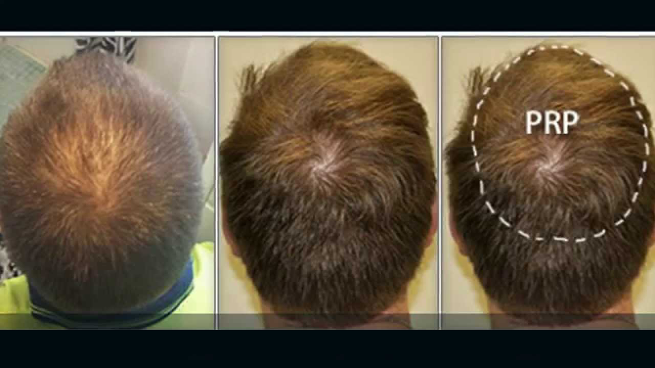 Hair Loss Problem Why Not Consider Prp Treatment