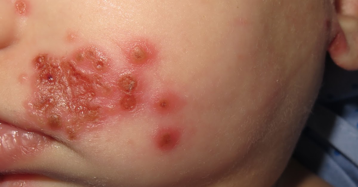 Dermapixel Primoinfección herpética en pediatría y
