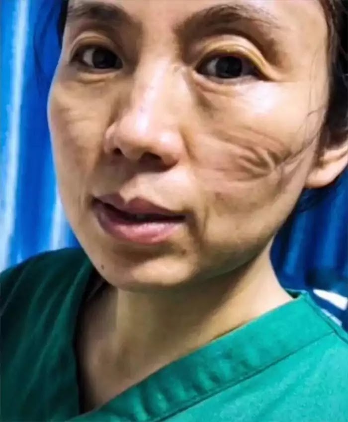 Shocking Photos Depict How Chinese Nurses' Faces Look After Hours Of Treating The Coronavirus