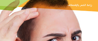 زراعة الشعر بالاقتطاف زراعة الشعر بالاقتطاف
