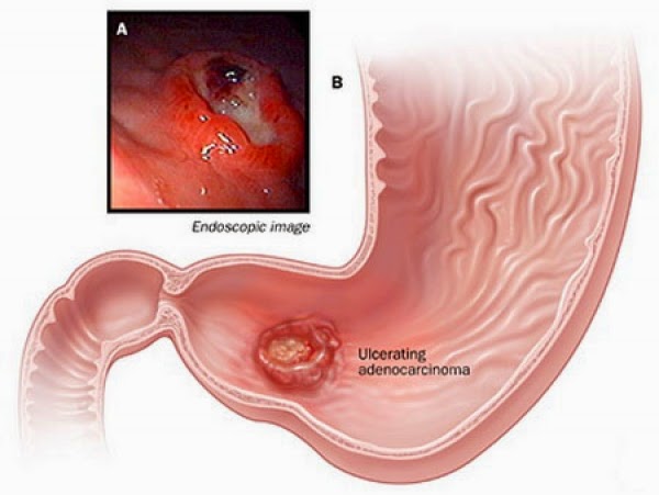 cancer gastric stadiul 4)