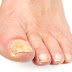 Best Home Remedies To Cure Toenail Fungus