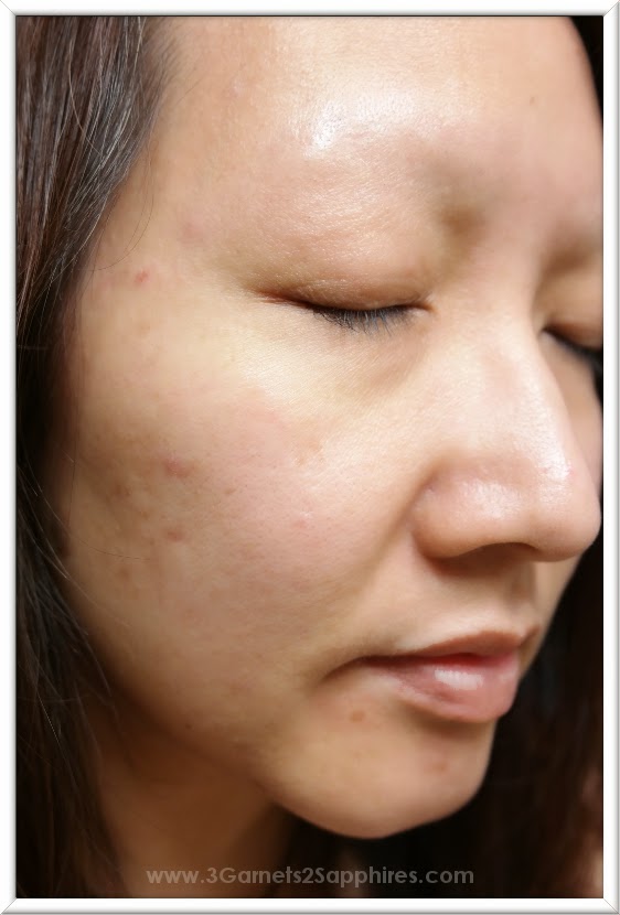 3 & 2 Sapphires Devising a Plan of Attack Against My Adult Acne with the Help of Silk’n