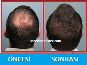 saç mezoterapisi öncesi ve sonrası 9