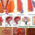 obat wasir bentuk peluru thumbnail