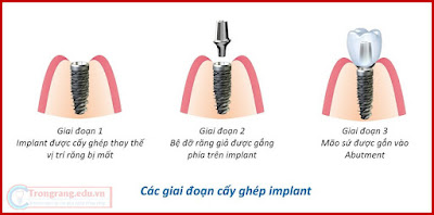 Khi nào thì nên cấy ghép Implant?